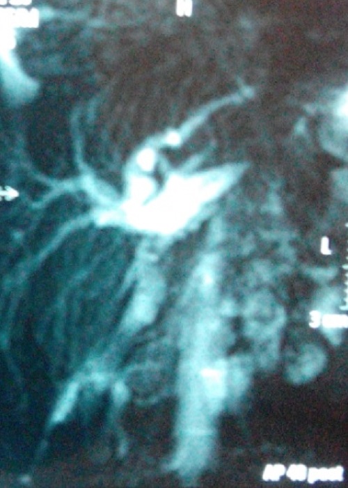 Morgagni Hernia Presenting As Obstructive Jaundice Raj APSP Journal 